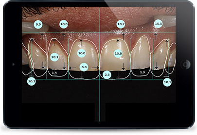 smile design pro